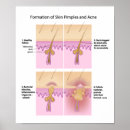 Pesquisar por acne Dermatologia