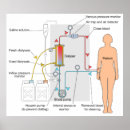 Pesquisar por diagrama médico pôsteres pósteres Hemodiálise