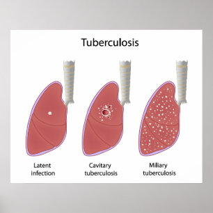 A tuberculose datilografa o poster