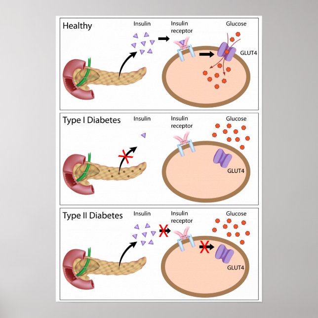 Ação de insulina e diabetes tipo 1 e 2 Poster (Frente)