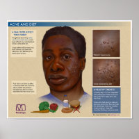 Acne melálica e Poster médica de dieta