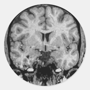 Adesivo Cérebro MRI, fatia coronal