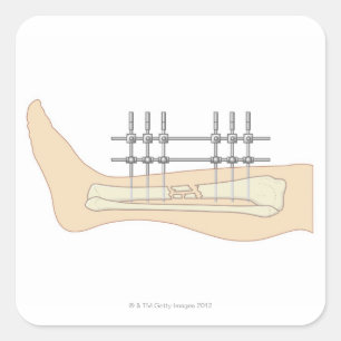 Adesivo Quadrado Fixator externo