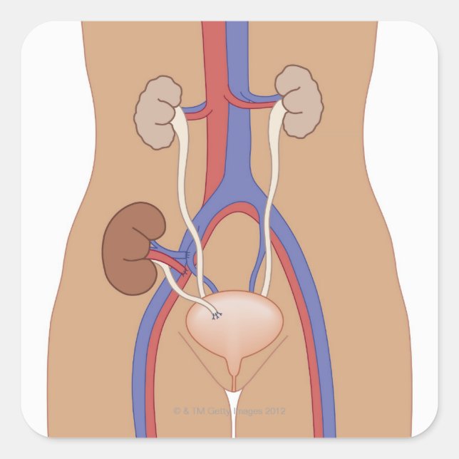 Adesivo Quadrado Transplante renal (Frente)