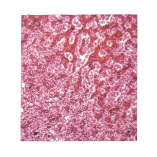 Bloco De Notas Pilhas de fígado humanas com cancer