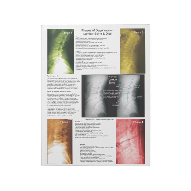 Bloco De Notas Rasgar A Derramação Da Espinal Lombar (Invertido)