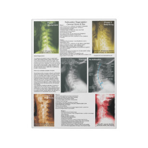 Bloco De Notas Rasgue fora a degeneração cervical do Subluxatio