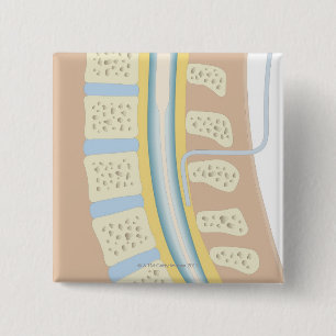 Bóton Quadrado 5.08cm Anestesia Epidural