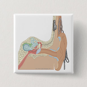 Bóton Quadrado 5.08cm Implantes cocleários