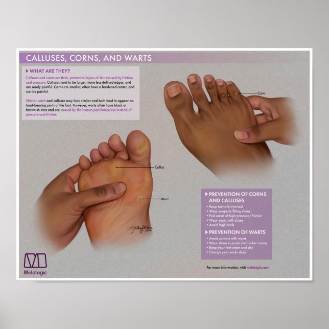 Calluses, cornos e verrugas Poster (Frente)
