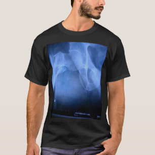 Camiseta fémur quebrado