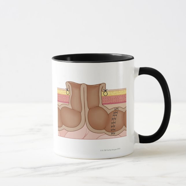 Caneca Colostomia provisória (Direita)