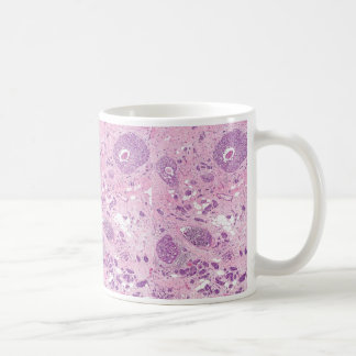 Caneca De Café Células cancerosas do Caneca-Peito do café