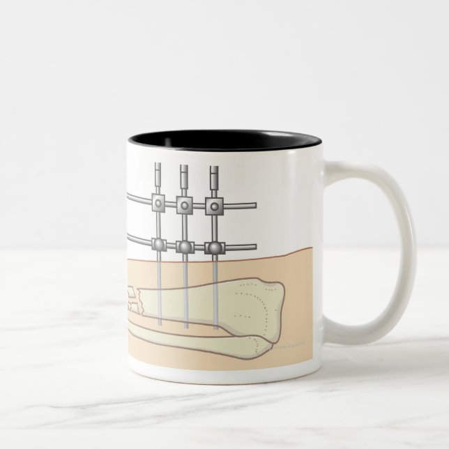 Caneca De Café Em Dois Tons Fixator externo (Direita)
