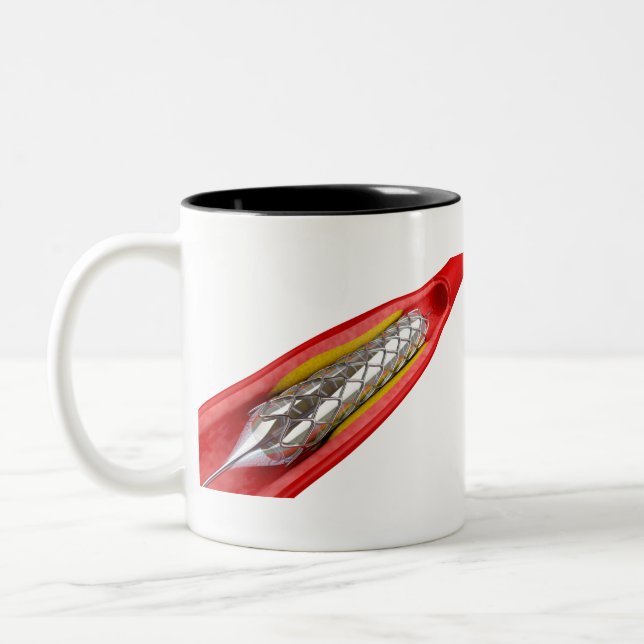 Caneca De Café Em Dois Tons Procedimento de angioplastia (Esquerda)