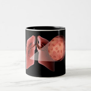 Caneca De Café Em Dois Tons Via aérea de Inflammed durante um ataque de asma