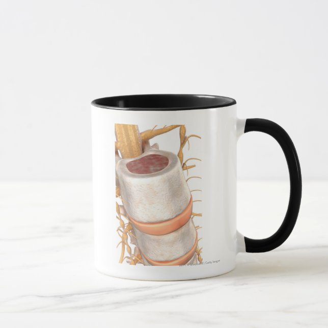 Caneca Feche acima de um disco invertebral na espinha (Direita)