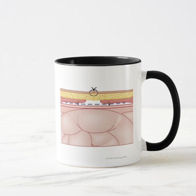 Caneca Ilustração de uma hérnia (Direita)