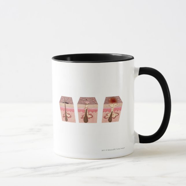Caneca Vista do que causa a acne (Direita)