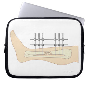 Capa Para Notebook Fixator externo