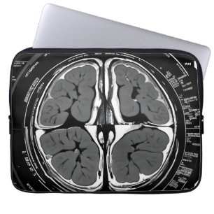 Capa Para Notebook ressonância magnética cerebral
