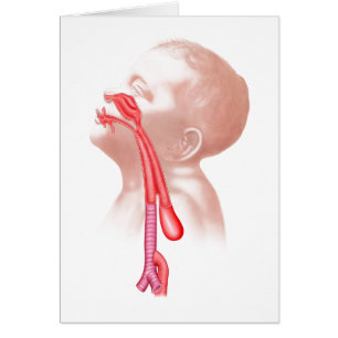 Cartão Anatomia de uma fístula Tracheoesophageal