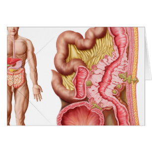 Cartão Ilustração da diverticulose nos dois pontos