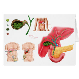 Cartão Ilustração Representando Colecistectomia