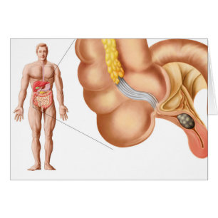 Cartão Ilustration médico de um apêndice
