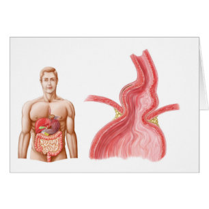 Cartão Ilustration médico de uma hérnia Hiatal no