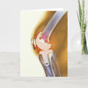 Cartão Knee replacement. Coloured X-ray of a total knee