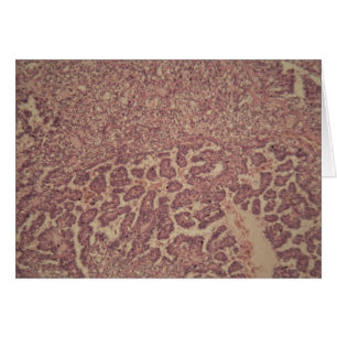 Cartão Pilhas da glândula de tiróide com cancer