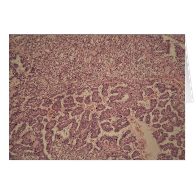 Cartão Pilhas da glândula de tiróide com cancer (Frente Horizontal)