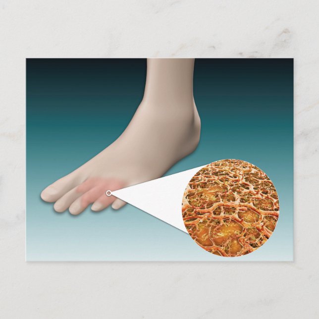 Cartão Postal Anatomia Do Fungo Pé Com Fechamento Microscópico (Frente)