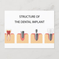 Estrutura do implante dental
