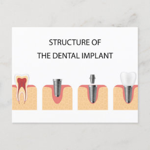 Cartão Postal De Anúncio Estrutura do implante dental