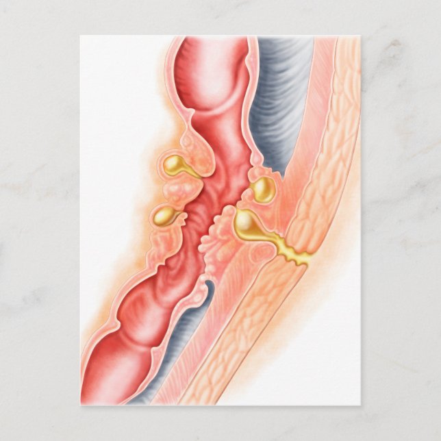 Cartão Postal Desenvolvimento De Fístula (Frente)