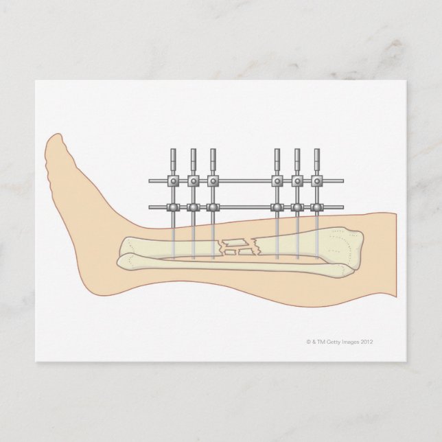 Cartão Postal Fixador externo (Frente)