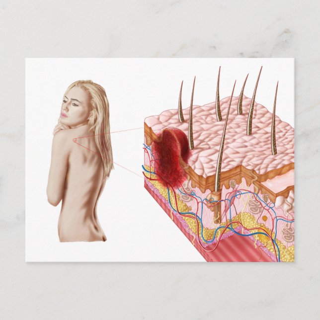 Cartão Postal Ilustração De Crescimento Atípico Na Pele (Frente)