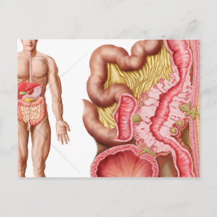 Cartão Postal Ilustração de Diverticulose no Cólon