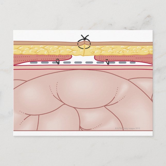 Cartão Postal Ilustração de uma Hérnia (Frente)