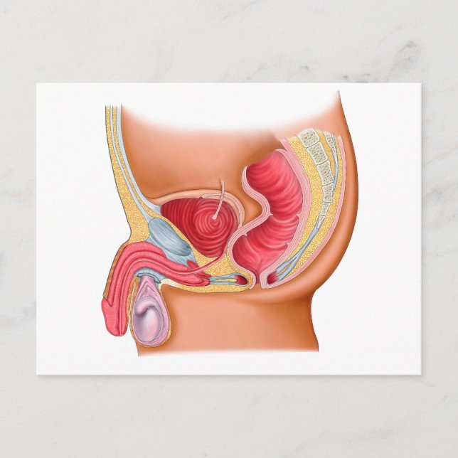 Cartão Postal Ilustração Médica De Fístula Rectórica (Frente)