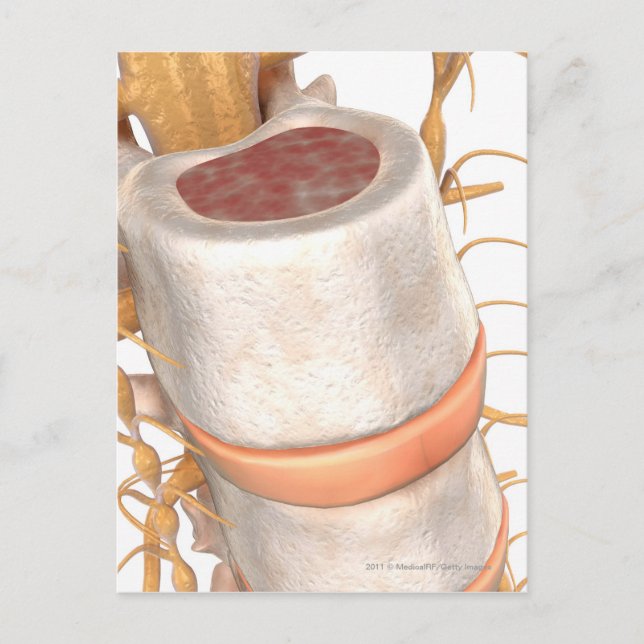 Cartão Postal Primeiro plano de um disco invertebral na coluna v (Frente)