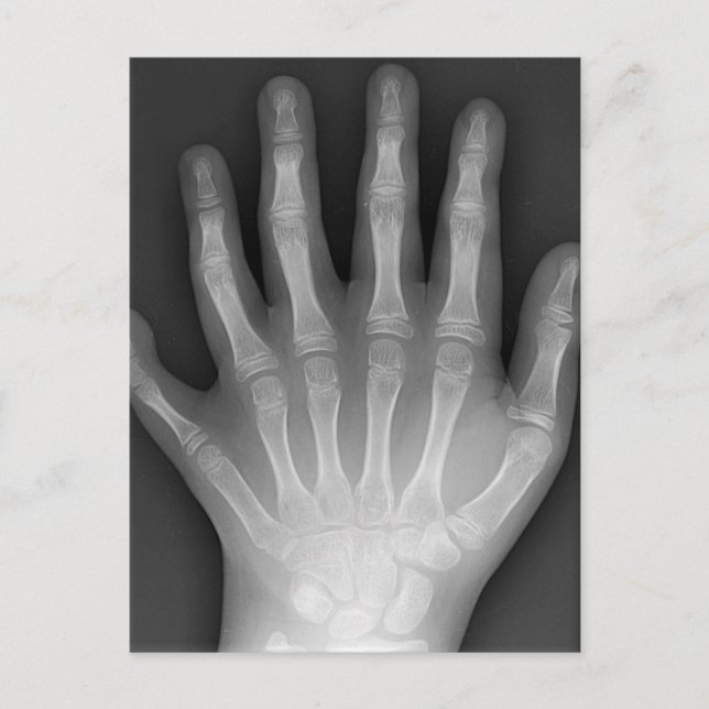 Cartão Postal Six Fingered Hand, Medical Rarity, X-Ray (Frente)