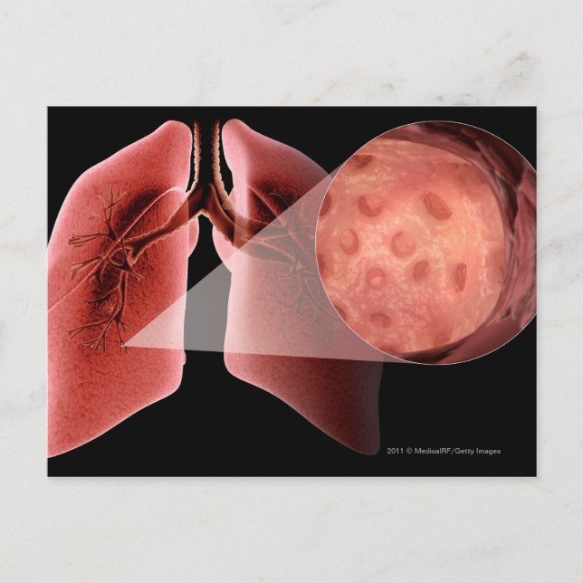 Cartão Postal Via respiratória inflamada durante um ataque de as (Frente)