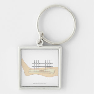 Chaveiro Fixator externo