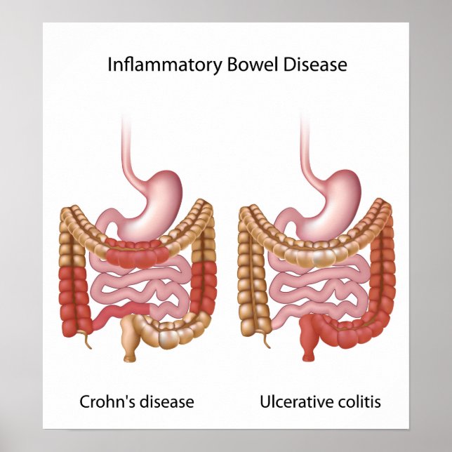 doença inflamatória intestinal (ibd) poster (Frente)