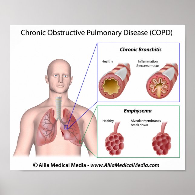 Doença pulmonar DPOC marcada com Poster (Frente)