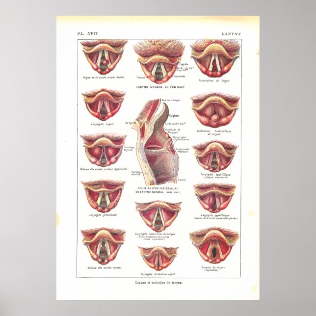Doenças da Anatomia Larynx Poster francês (Frente)