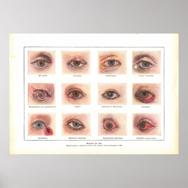 Doenças da Anatomia Ocular Poster francês (Frente)